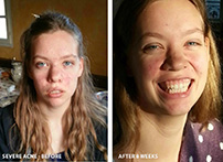 Mild Cystic acne  - before - after 4 weeks