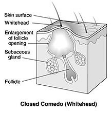 Closed Comedo (Whitehand)