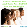 5 Facts You Didn’t Know About Cystic Acne That Will Help You Get Rid of It