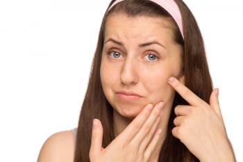 Adult Hormonal Acne and Stress