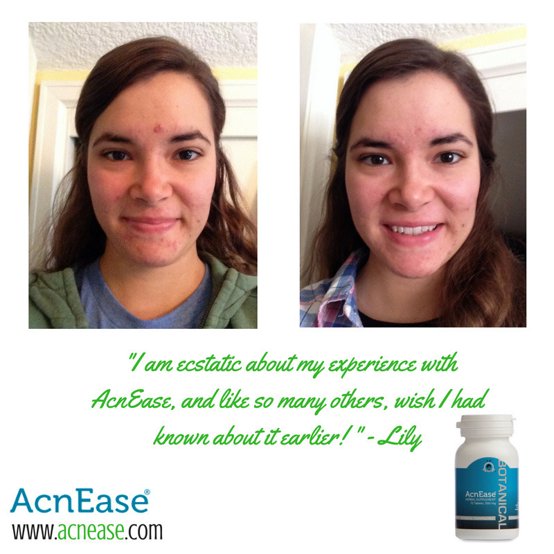 5 Ways AcnEase Works to Treat Adult and Cystic Acne Naturally 