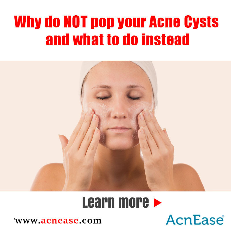 Why do NOT pop your Acne Cysts and what to do instead