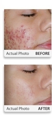 Selecting the Right Acne Treatment for Your Skin