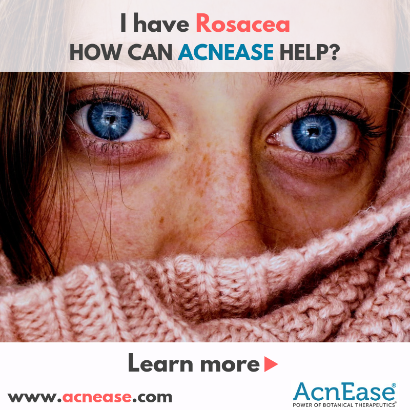 I have rosacea. How can AcnEase help?