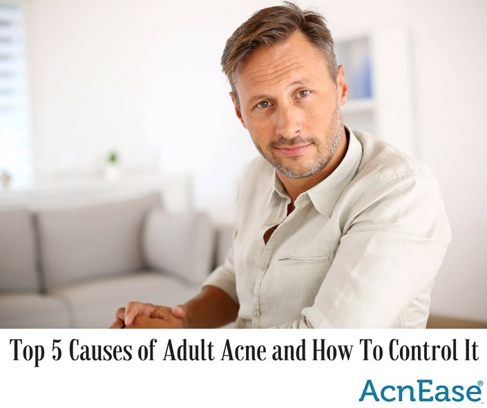 Top 5 Causes of Adult Acne and How to Control It