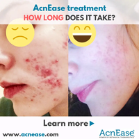 How long does the AcnEase treatment takes?