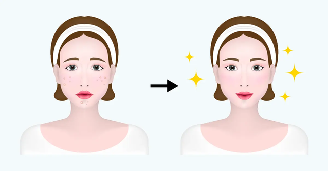 Most Often Asked Acne Questions