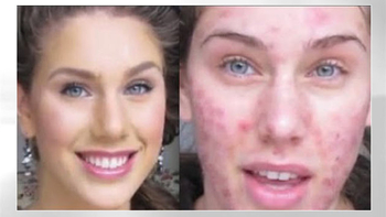 Acne-Plagued Teen Lands Spot on Fashion Week Runway