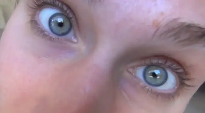 ACNE UPDATE!!!! Summer, Antibiotics, & Water! Acne Journal + What I'm Using + Thoughts:) 