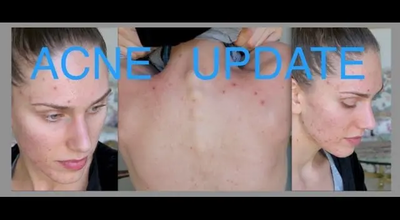 Acne Update For Acne Awareness Month! Sunscreen, Skincare Routine, Summer & Herbal Supplements!